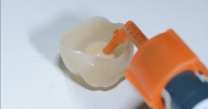 Protegido: Cementación adhesiva de postes