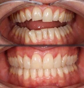 Protegido: Descubra cómo la Dra. Ida Louise Line utiliza composite calentado.