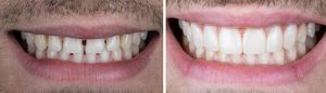 Protegido: Composite Universal 3M™ Filtek™ Easy Match 