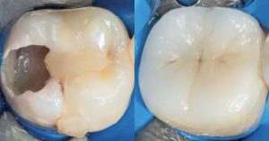 Terapia pulpar vital en caries profundas