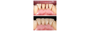 Técnica de composite inyectado en carillas directas con Solventum™ Filtek™ Easy Match Fluido 
