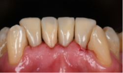 El Dr. Cristiano Bonacina usó la técnica de composite inyectado con el Solventum™ Filtek™ Easy Match Fluido para restauraciones de carillas directas de aspecto natural. 